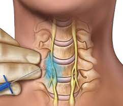 The stellate ganglion block reduces pain by injecting anesthesia into the neck. 